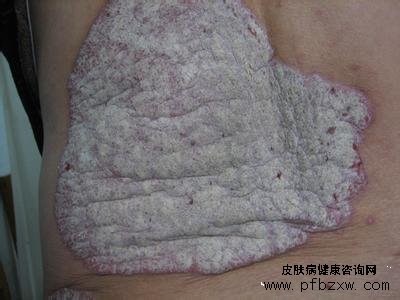 男性腰部大片牛皮癣反反复复症状图片